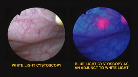 Blue Light Cystoscopy