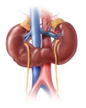 Horseshoe Kidney