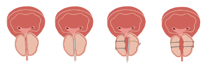 Urolift