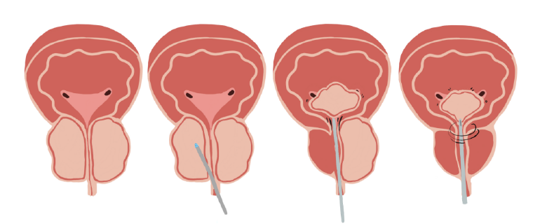 HoLEP is a procedure that uses a laser to remove prostate tissue that is blocking urine flow