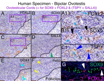 human bipolar ovotestis specimen