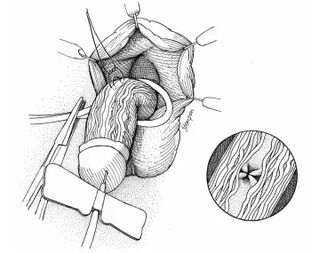 Nerve Sparing Dorsal Plication Technique