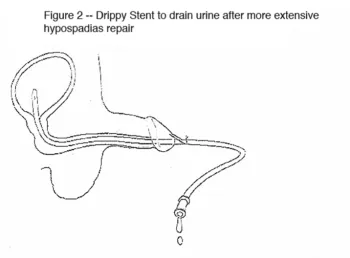 Hypospadias and Chordee Repair_image 1
