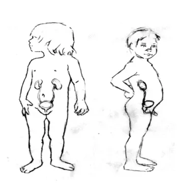 Pediatric Urology_Child Continence Espanol_image 1