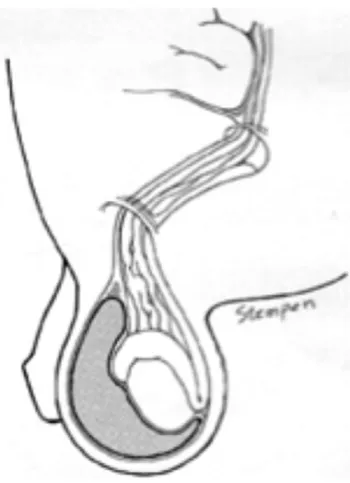 Pediatrics_Hydrocele_image 1