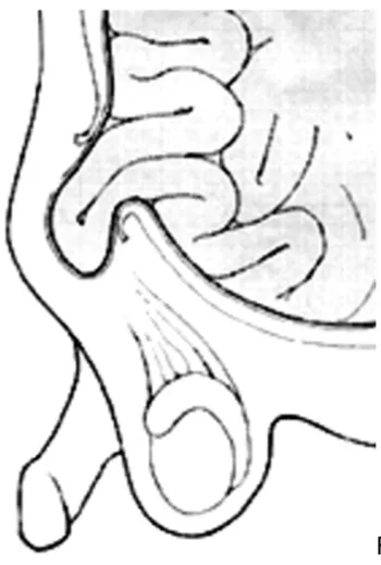 Pediatrics_Hydrocele_image 2