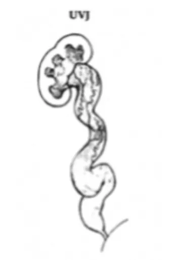 Pediatrics_Megaureter_image 1