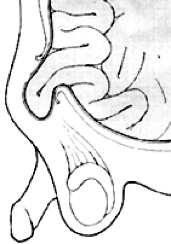 Hernia / Hydrocele Figure 2