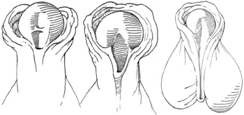 Subcoronal, midshaft, penoscrotal