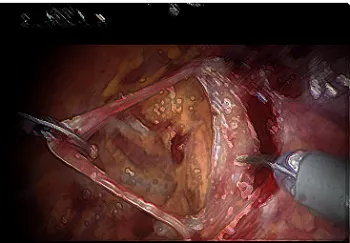 Harvesting the Sling