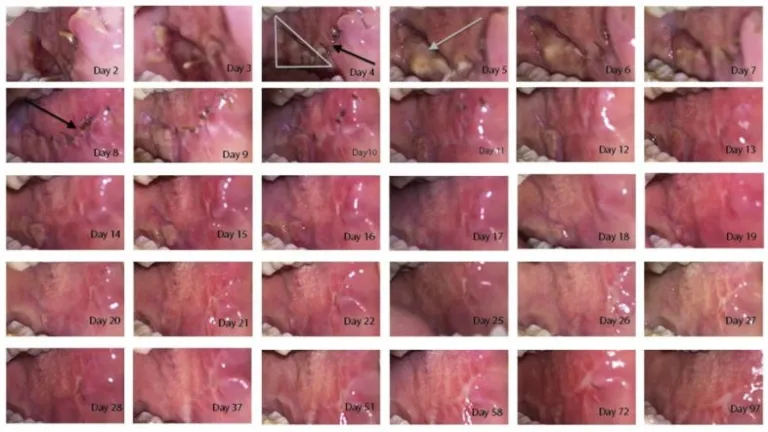 Buccal mucosal graft represents the gold standard graft material for urethroplasty.