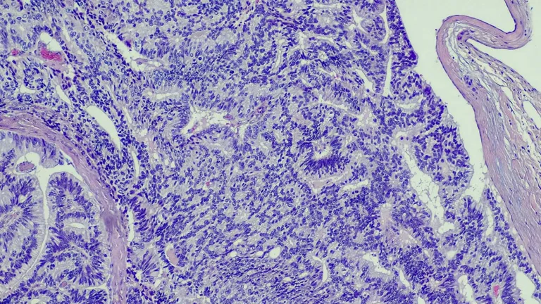 Why Some Prostate Cancers Shouldn’t Be Called ‘Cancer’_ UCSF.EDU press release