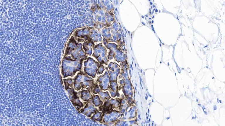 Micropapillary-bladder-cancer-UCSF Press Release image