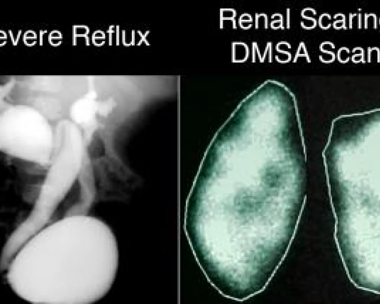 sever reflux scan
