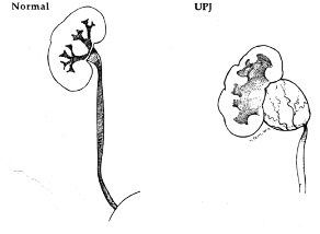 Figure 1 Ureteropelvic Junction Obstruction illustration