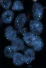 FISH on tissue section of a prostate cancer case; four copies for the probes MYC (red signals) and TBL1XR1 (green signals) are present in most cells. No signals for the PTEN-specific probe were observed, consistent with a biallelic deletion of this gene Ajpathology