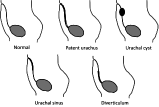 Urachus_Figure1