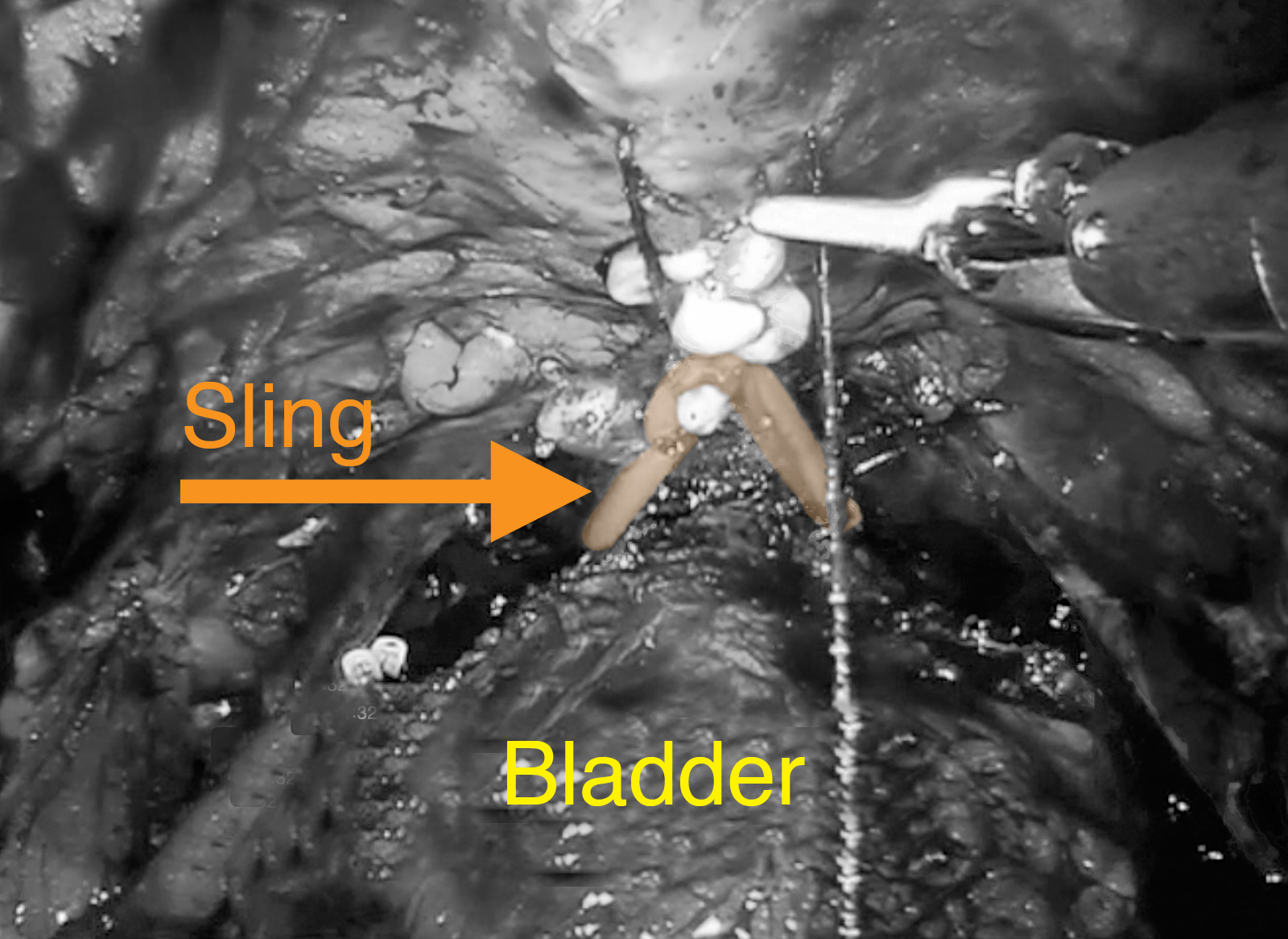 Sling procedure